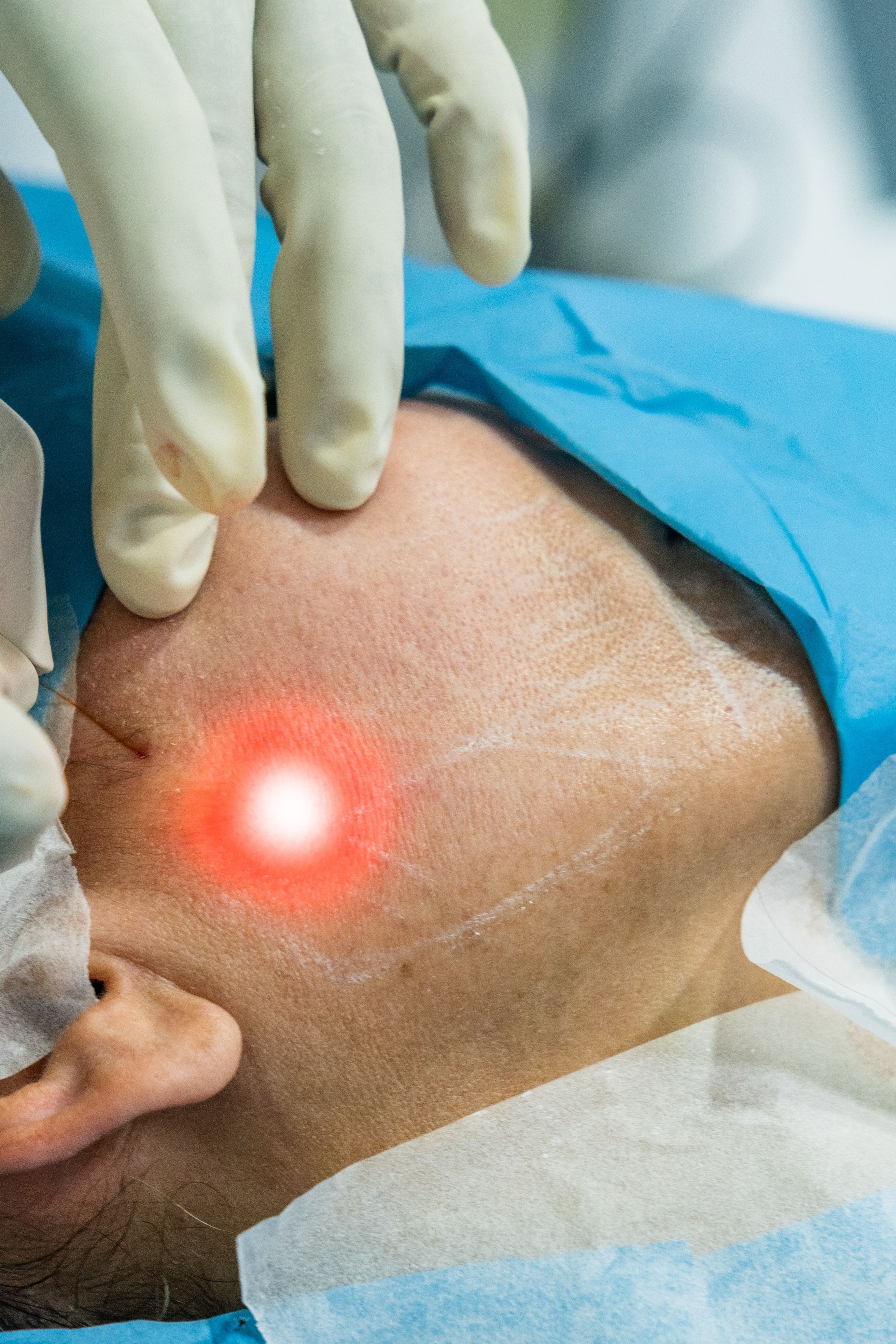 Endolift Facelift
