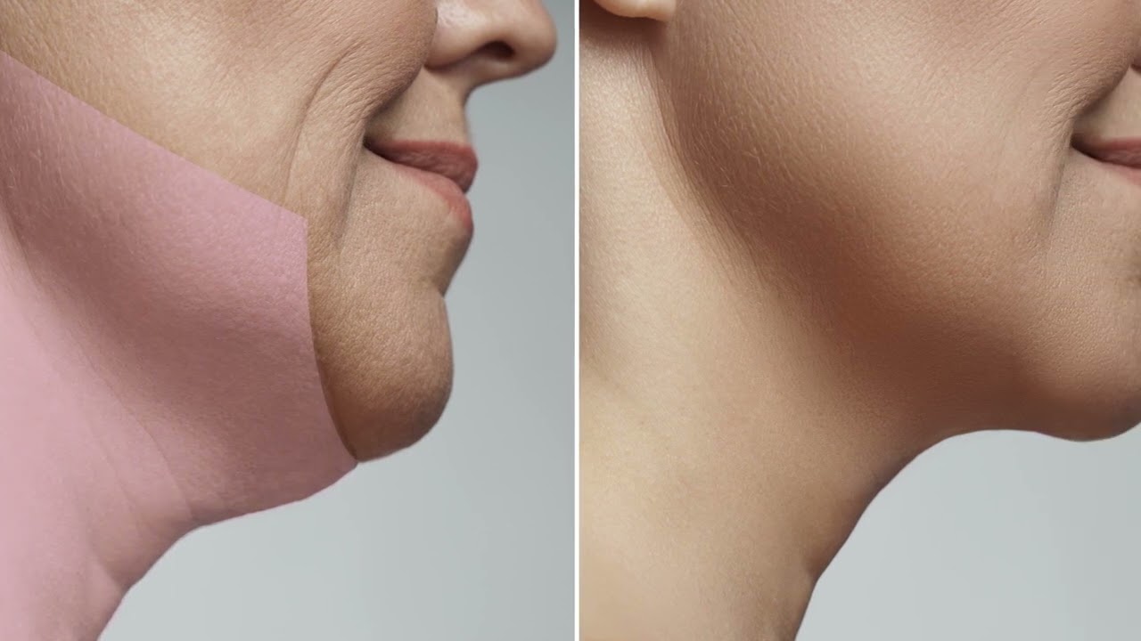 Endolift Body