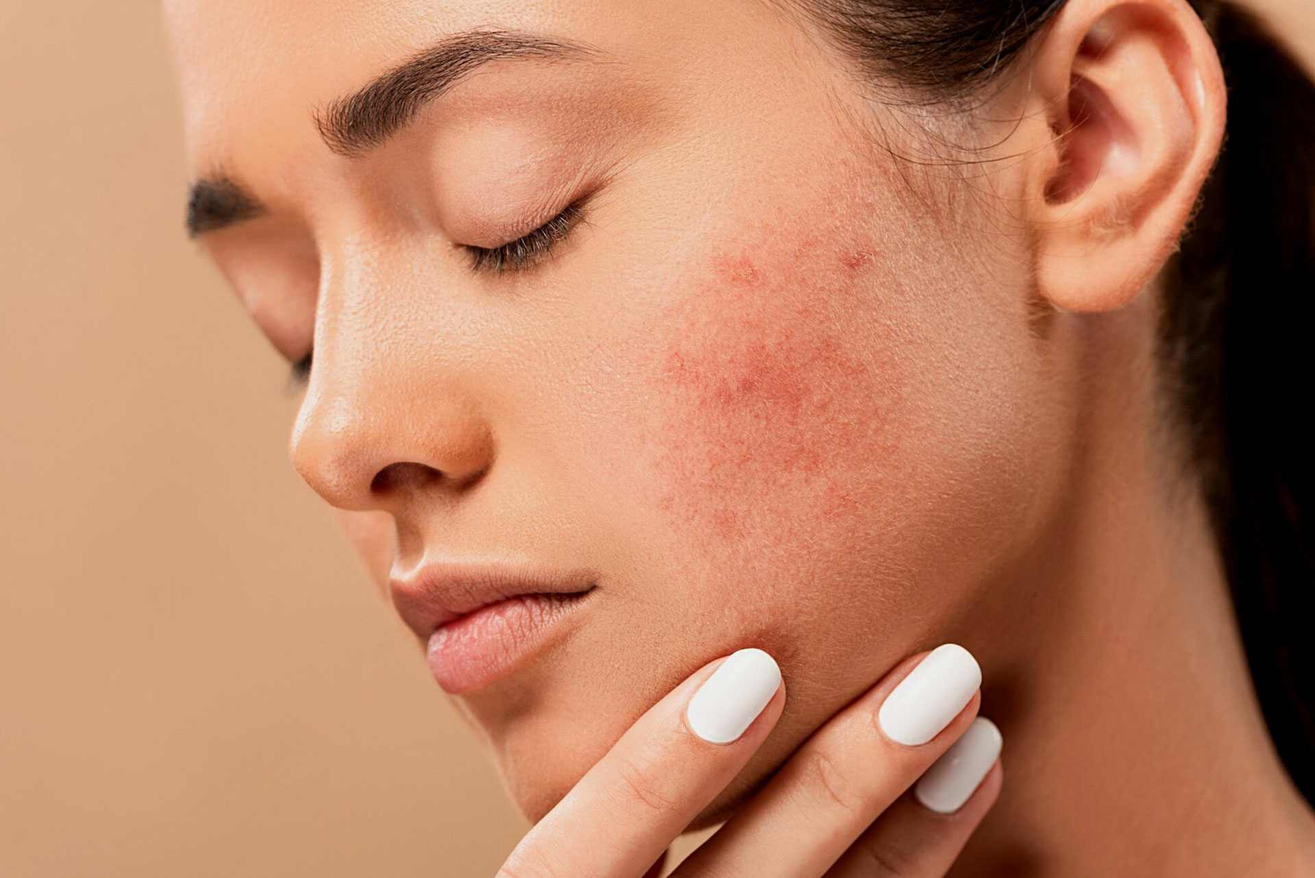 Intense Pulsed Light (IPL) Acne