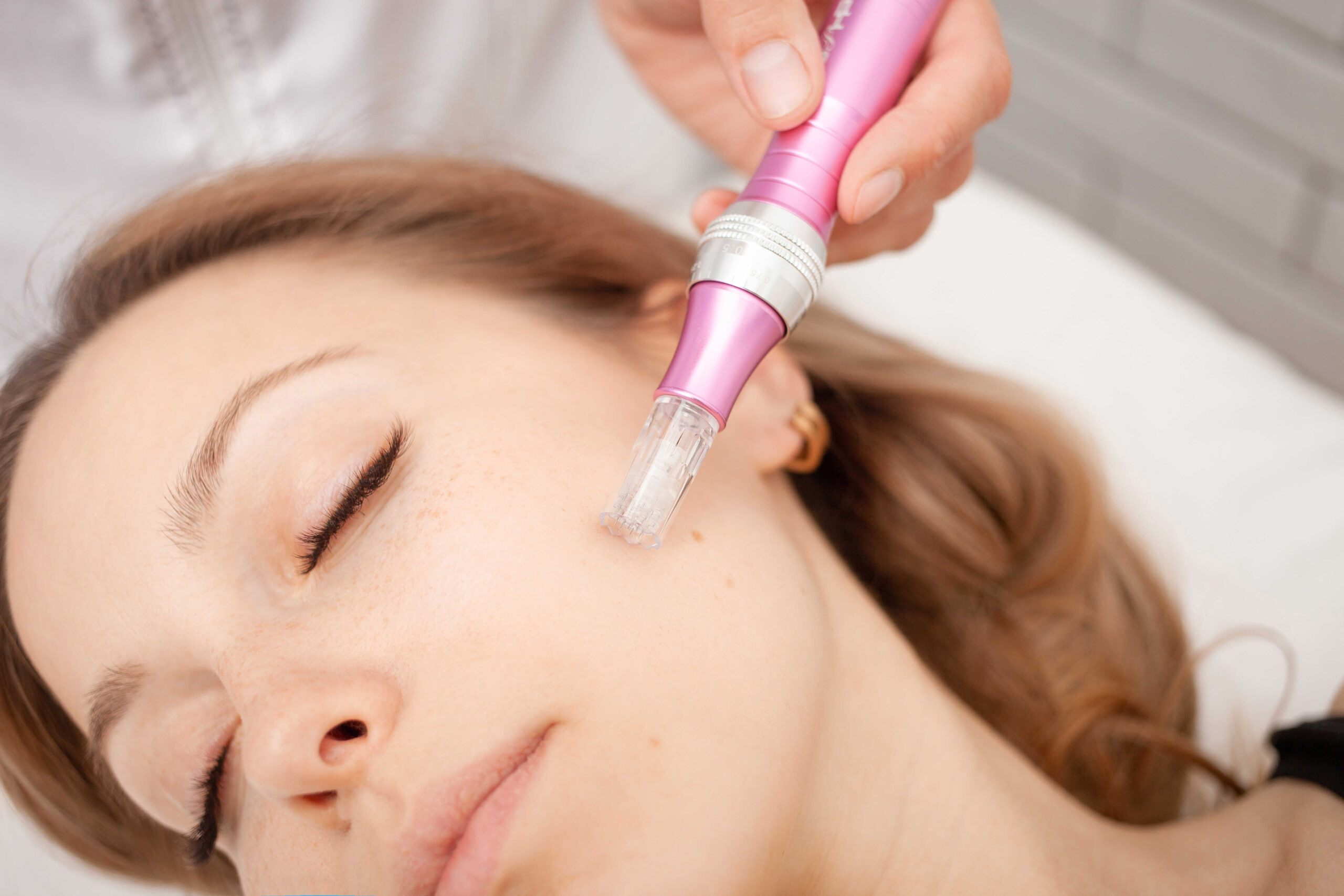 Microneedling with Platelet-Rich Fibrin (PRF)